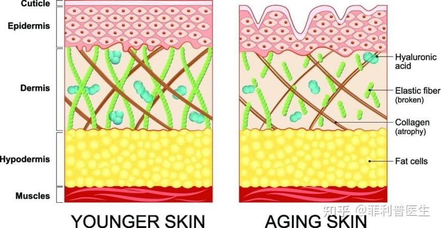 皮肤老化—皮肤胶原流失,弹力纤维断裂