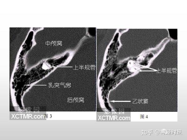面神经解剖及相关病变 - 知乎