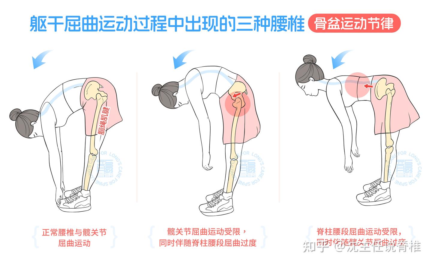 为什么每次弯腰都疼痛难忍,弯不下去?医生详细告知您处理思路 - 知乎