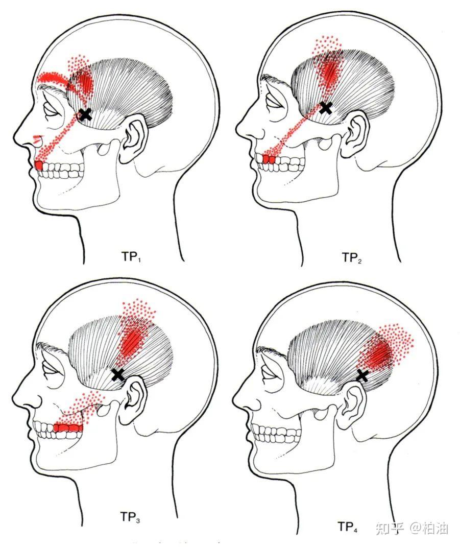 疼痛的位置主要在眼眶,太阳穴附近,我一般会建议首先按摩颞肌