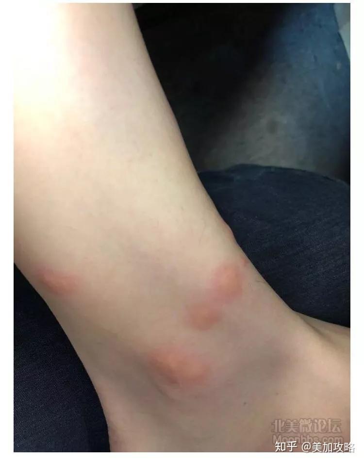 蚊子叮咬后的症状图图片