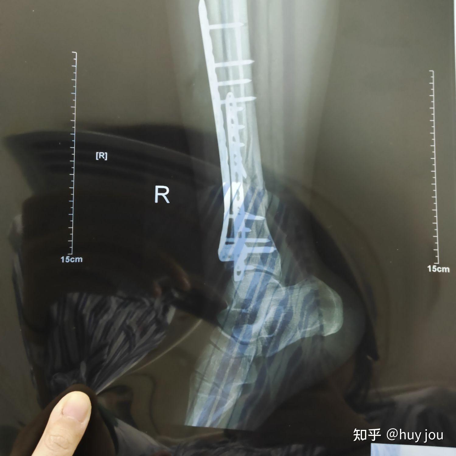 胫腓骨下段粉碎性骨折