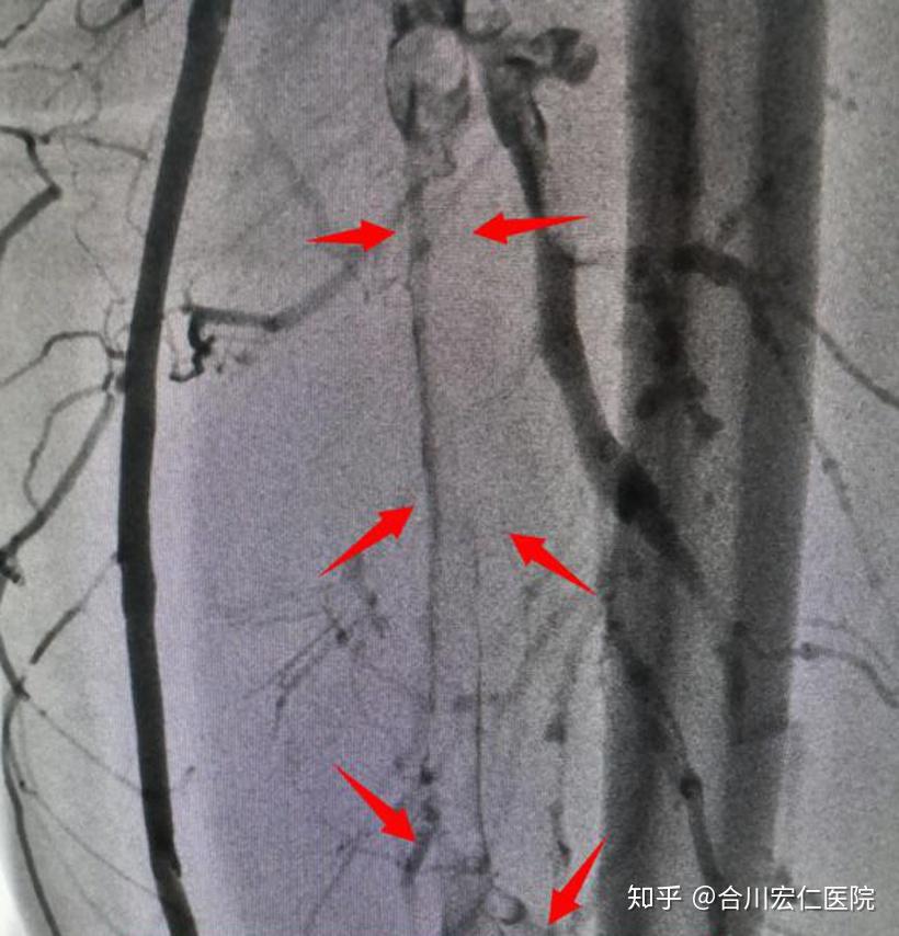 图解:左侧髂静脉完全堵塞,左下肢回心静脉血栓全靠侧支静脉代偿该患者