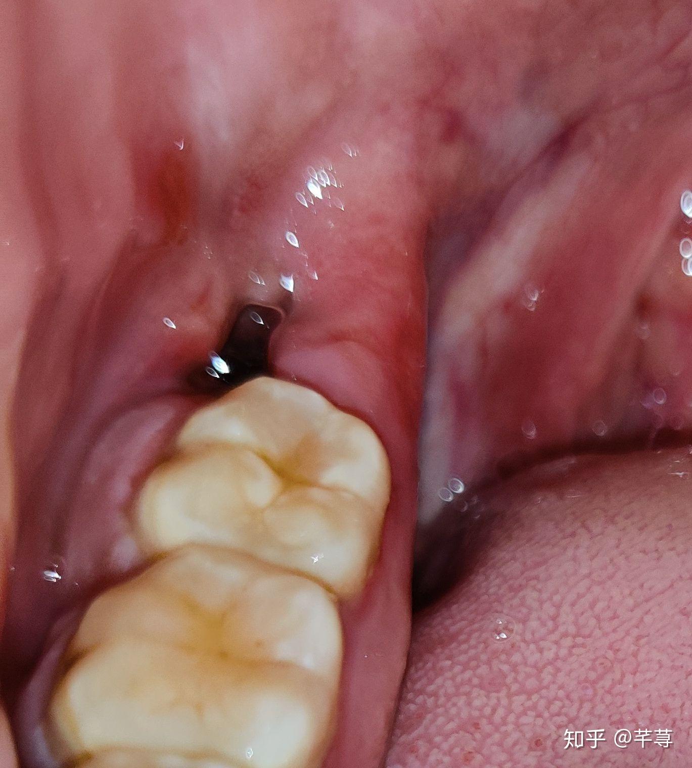 【宝妈提醒】1岁7个月宝宝牙齿全部烂光 原来是得了这种病！