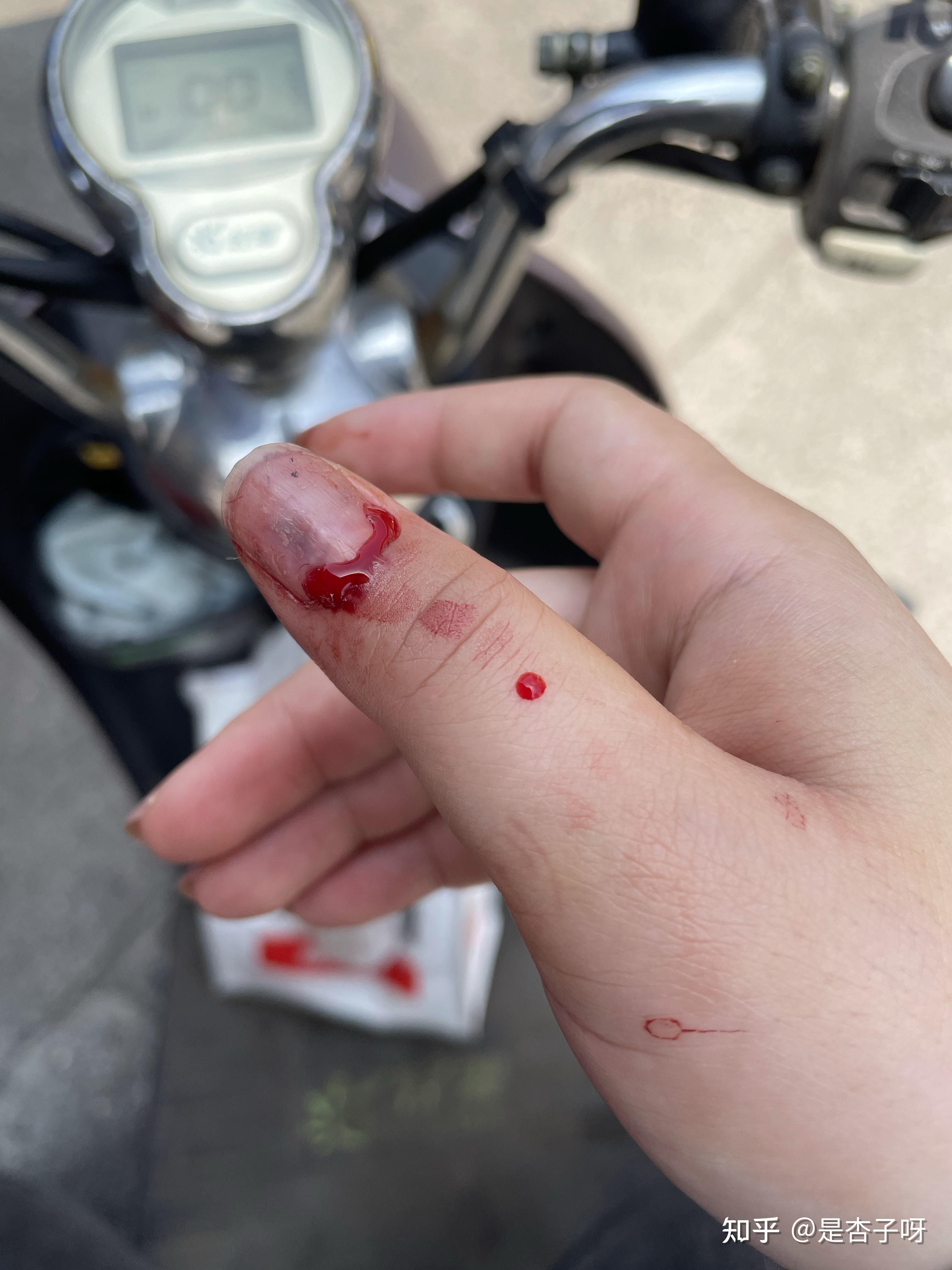 记录一次指甲被夹的经历 - 知乎