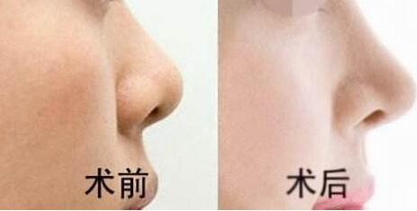 自体脂肪隆鼻手术恢复过程分享还有前后对比效果图片哦