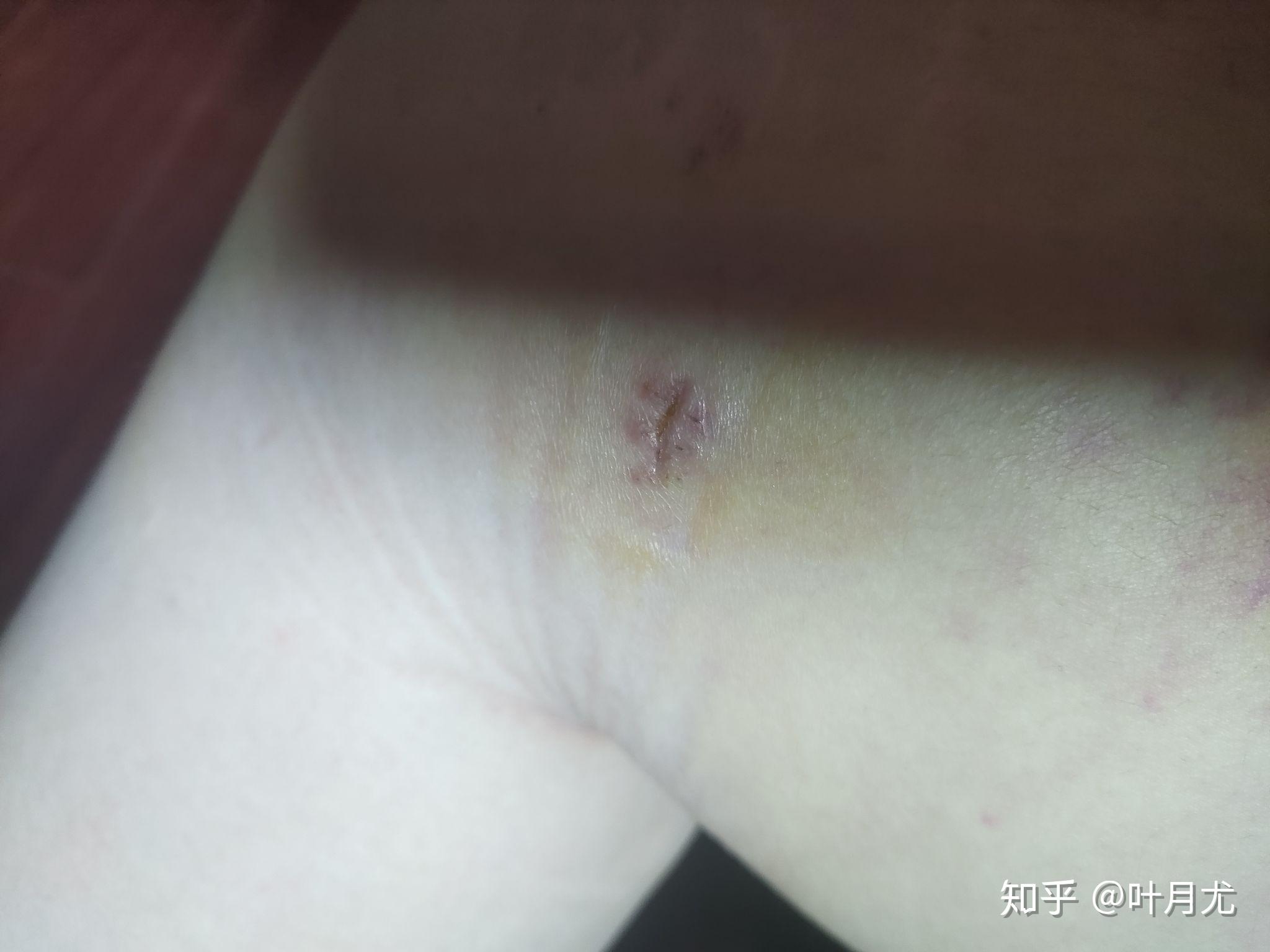 大腿环吸术后第12天真实感受,术后发硬
