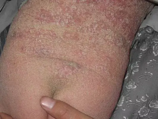 冬季干性湿疹图片图片