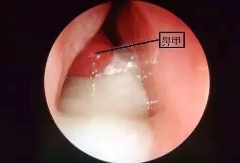 鼻窦炎从鼻孔看图片图片