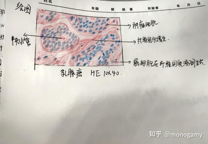 高分化腺癌红蓝铅笔图图片