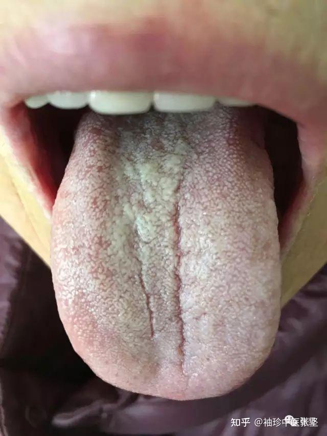 例子二:舌下青筋曲张其实还好,说明肝血管静脉系统的曲张,回流不畅