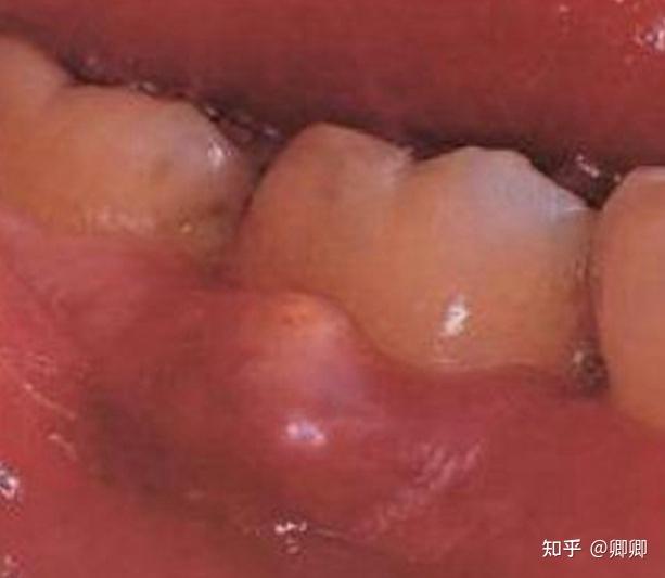 大牙牙龈肿痛化脓图片图片