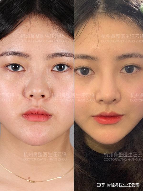 10条隆鼻面诊攻略|轻松get自然妈生鼻 - 知乎