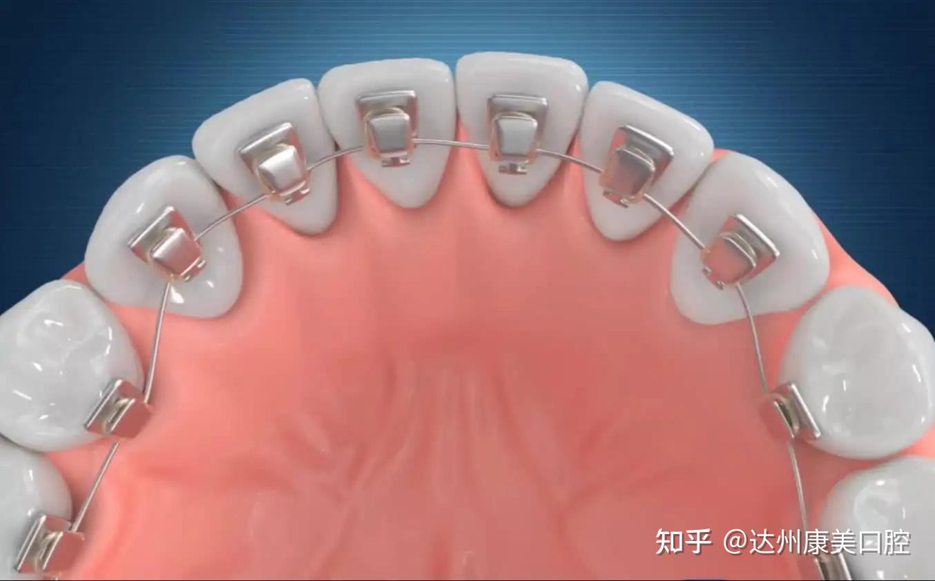 竟然还有舌侧矫治器,你了解它的优点吗? - 知乎