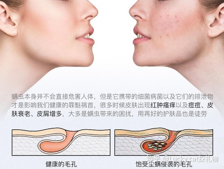 我们家里最常见的尘螨有两种,一种是粉尘螨,一种是户尘螨.