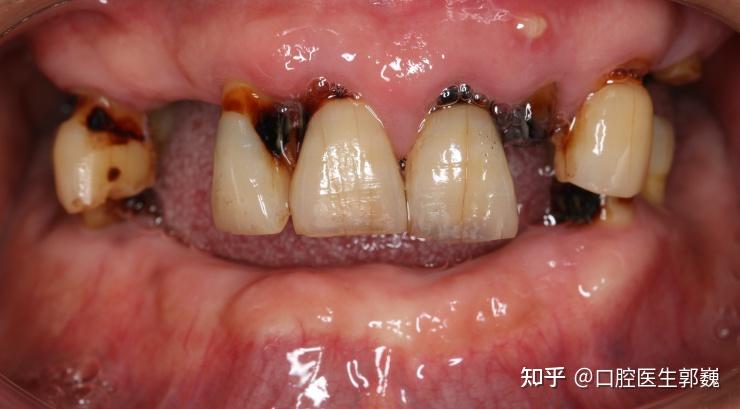 牙齿根面龋坏严重,左上2号牙根尖区有一个小落管儿,经常有脓液从内