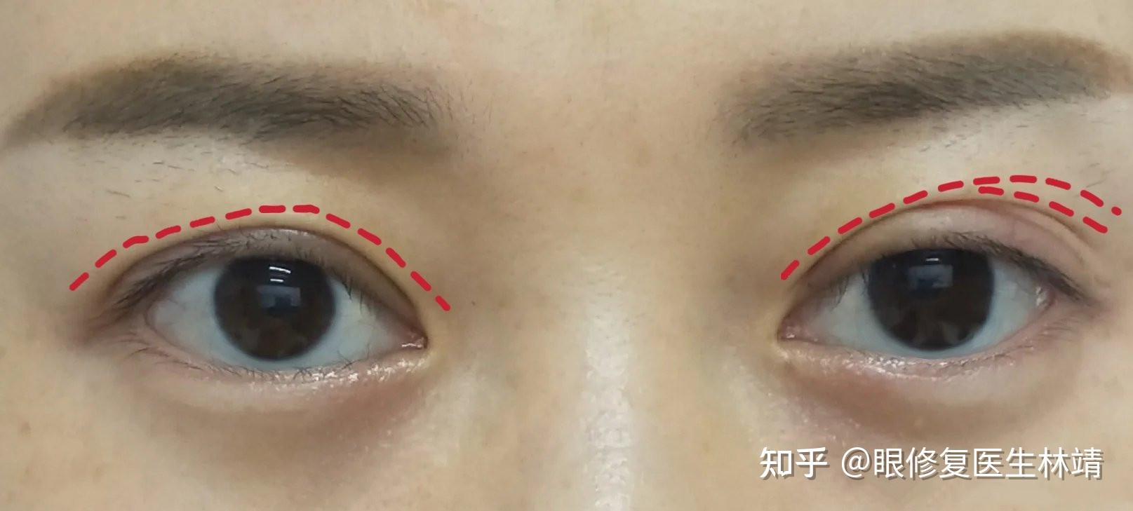 双眼皮术后眼头和眼尾出现分叉问题?怎么办?