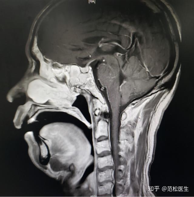 病例分享丨鼻咽癌放疗诱导的左上颌颅底骨肉瘤 - 知乎