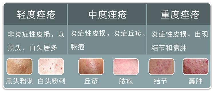 分不清楚是什么类型就盲目祛痘,所以痘痘总是反反复复,去不掉!