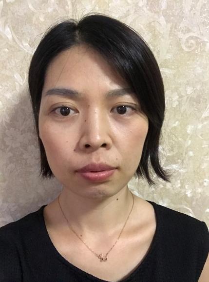 素人改造鼻孔外漏被評為全班最醜女生的姑娘能美成什麼樣