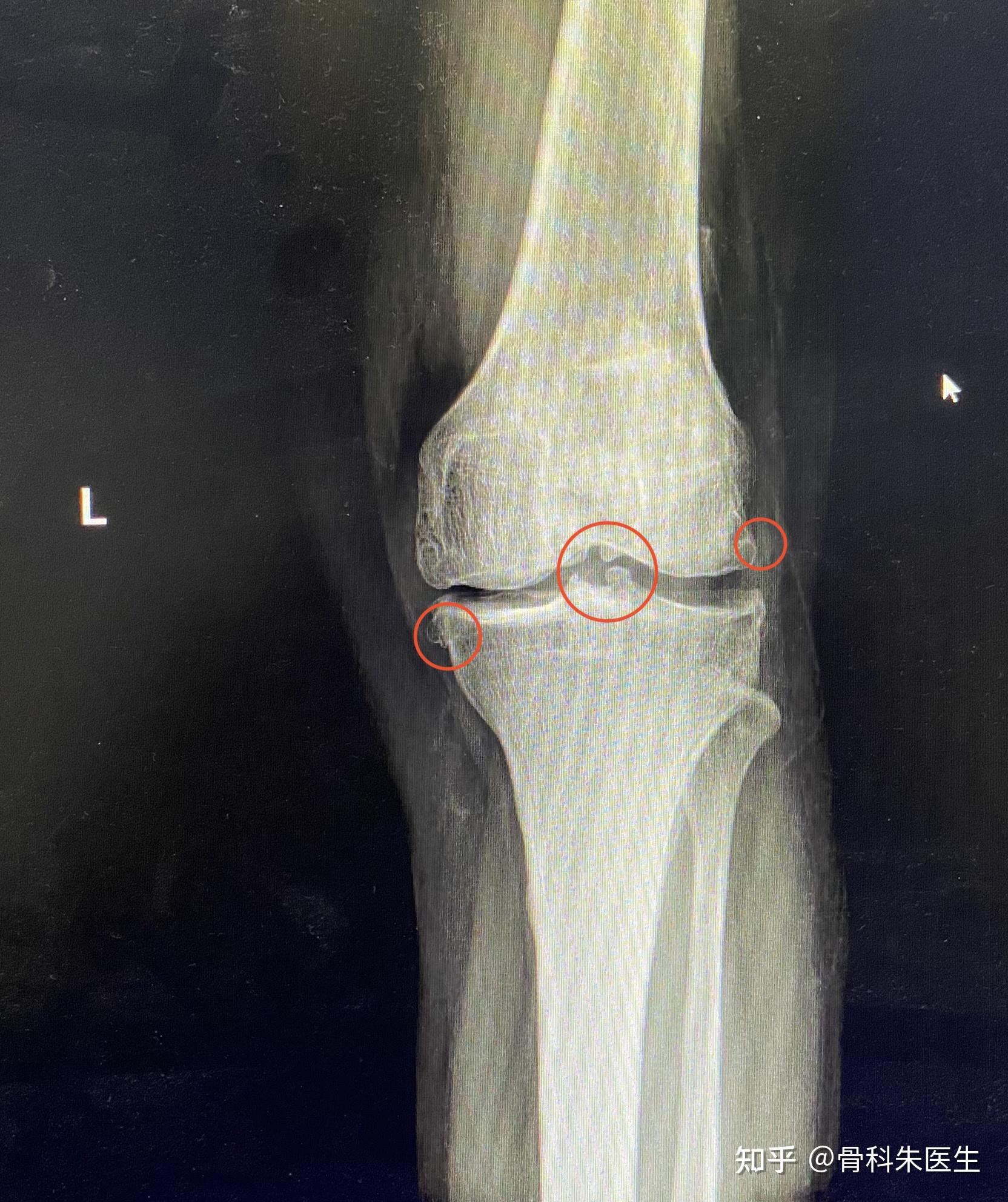 患者故事你的膝关节有骨刺吗应该怎么办