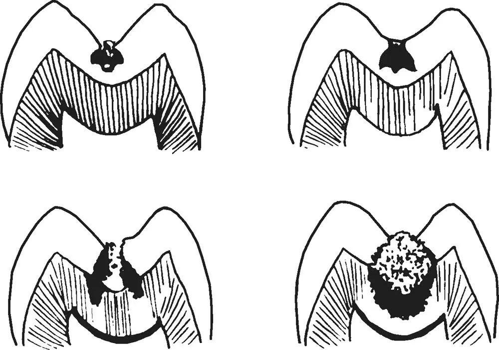 另外,由于釉质在窝沟底部牙厚度较薄,窝沟龋很容易进展到牙本质,造成