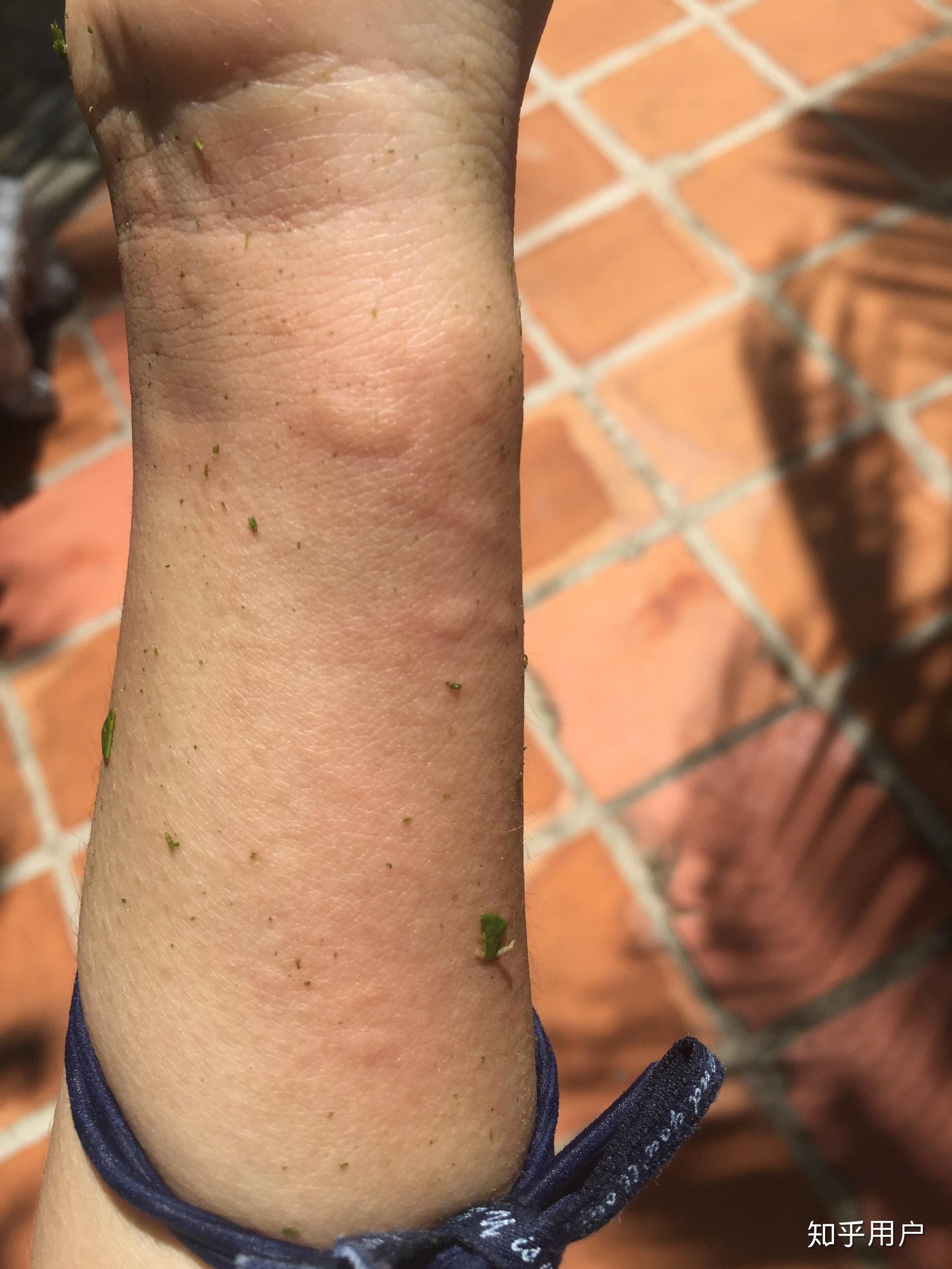 被水母蛰是一种什么体验