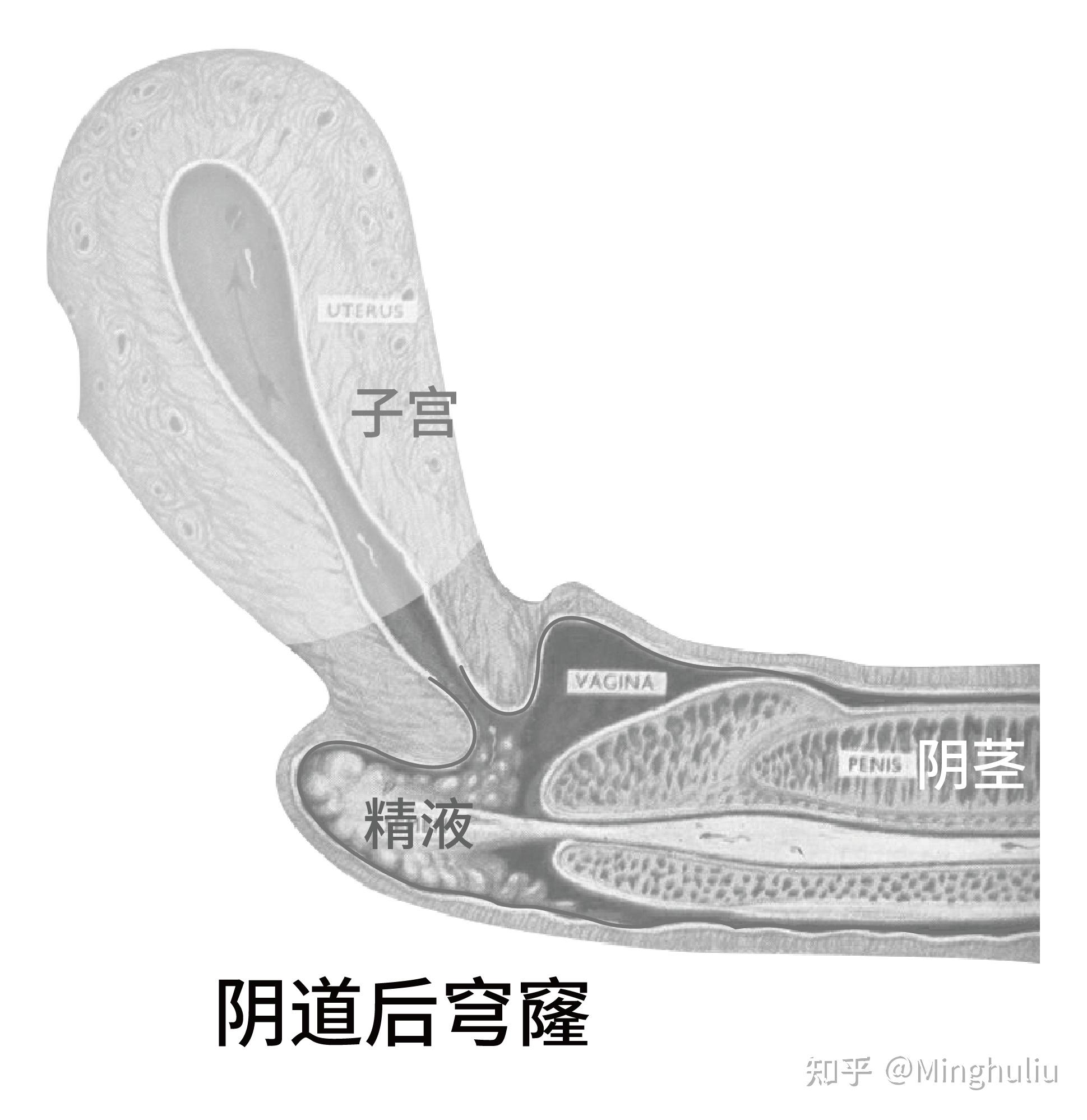 后穹窿穿刺步骤图解图片