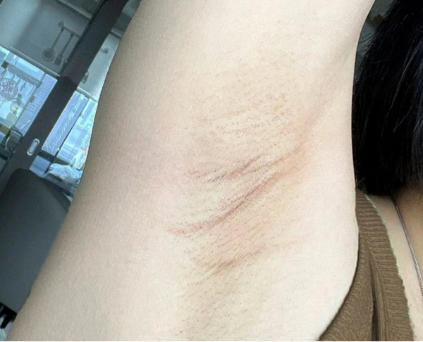 女生体毛旺盛怎么解决？有什么简单有效的脱毛方法推荐吗？不仅快速没毛茬儿，还能从猕猴桃变身水煮蛋，又白又滑！ - 知乎