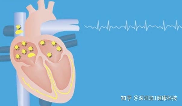 在心房颤动中,心脏的上腔比心脏的其他部分颤动得更快.