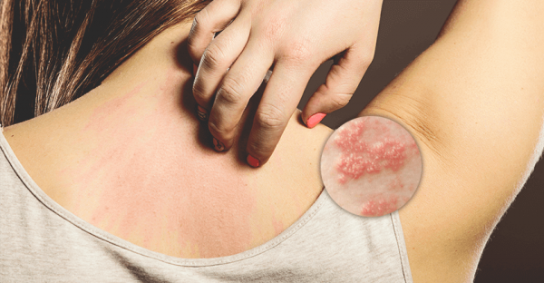 皮肤一粒粒痒痒抓不停到底是湿疹还是异位性皮肤炎 知乎