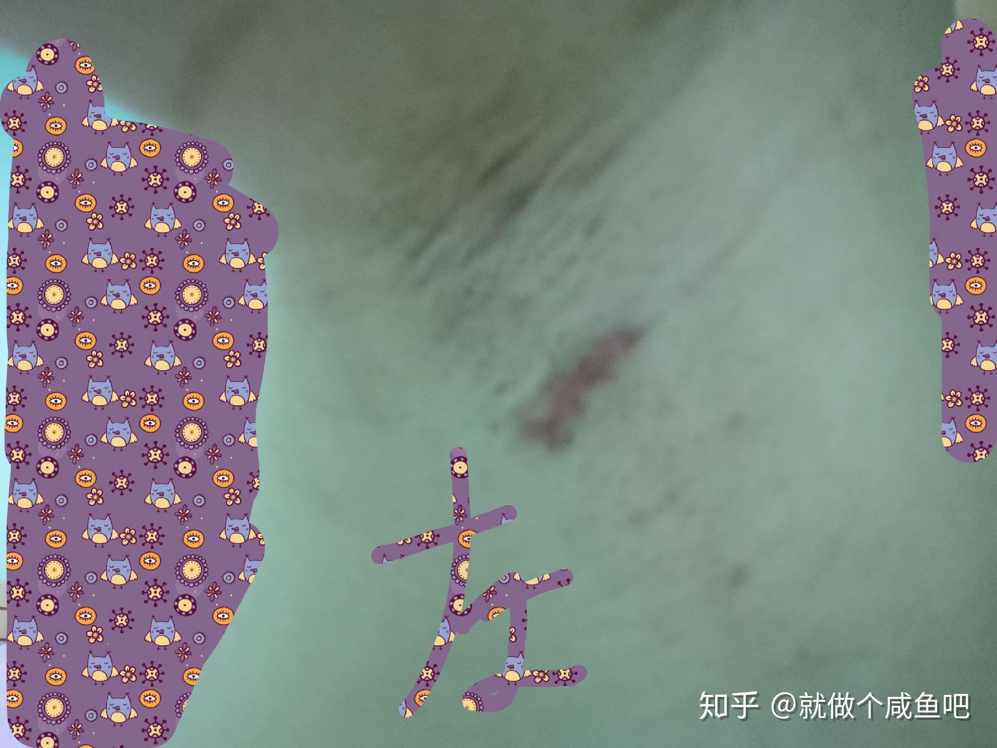 传统狐臭手术记录贴