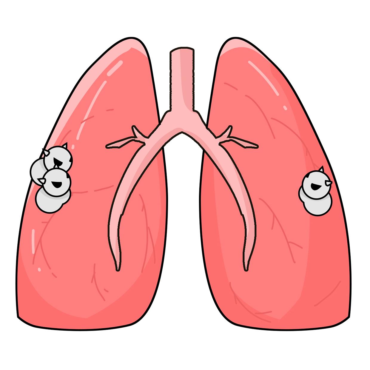肺结节 卡通图图片