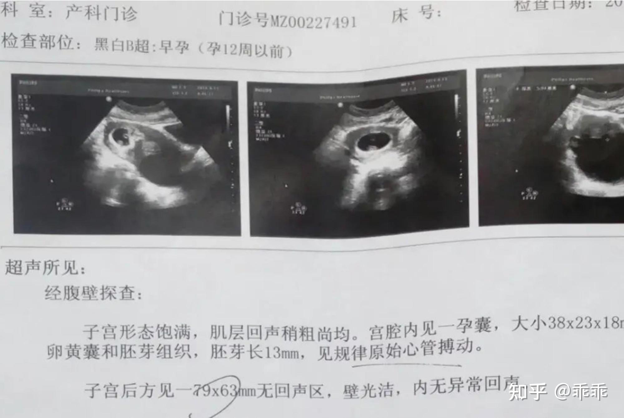 产检报告看不懂？记住这5项“数据指标”，胎宝就没有小秘密了 知乎