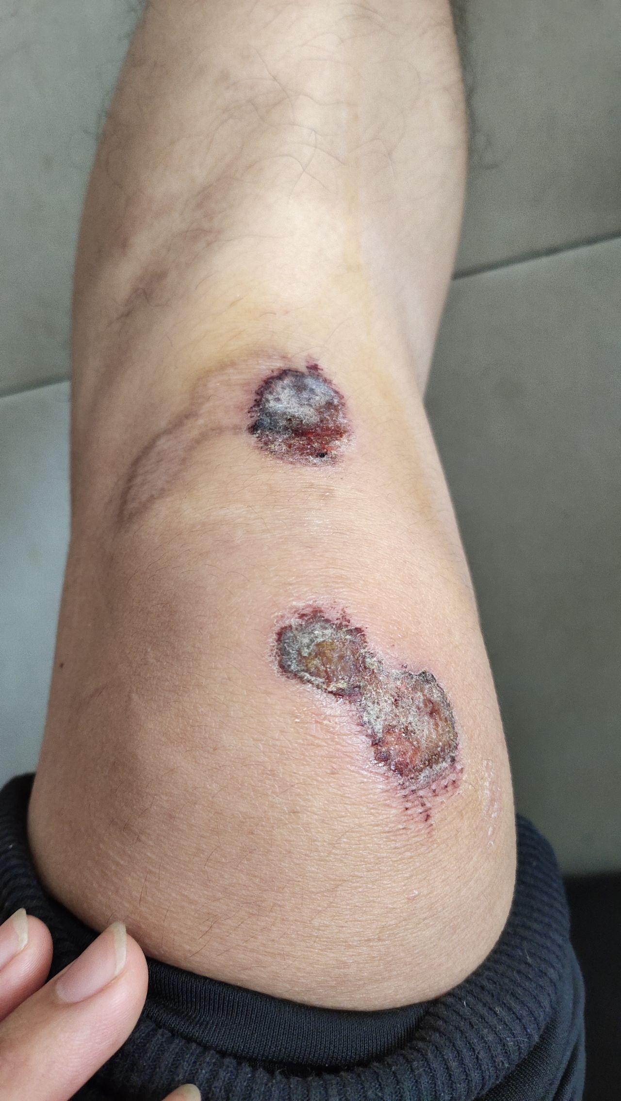 膝盖大面积擦伤