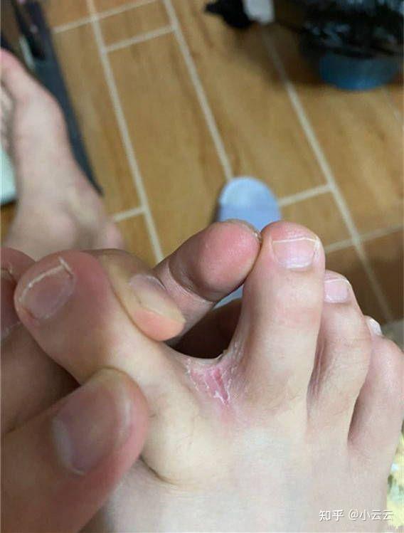 每年都是一到夏天就复发,我还是在高中的时候被传染上脚气的,那时候