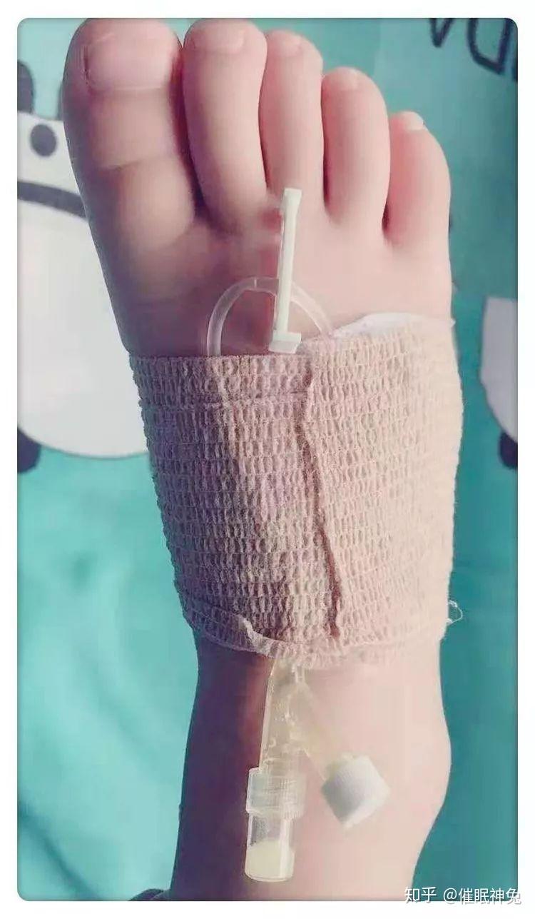 静脉留置针的使用介绍