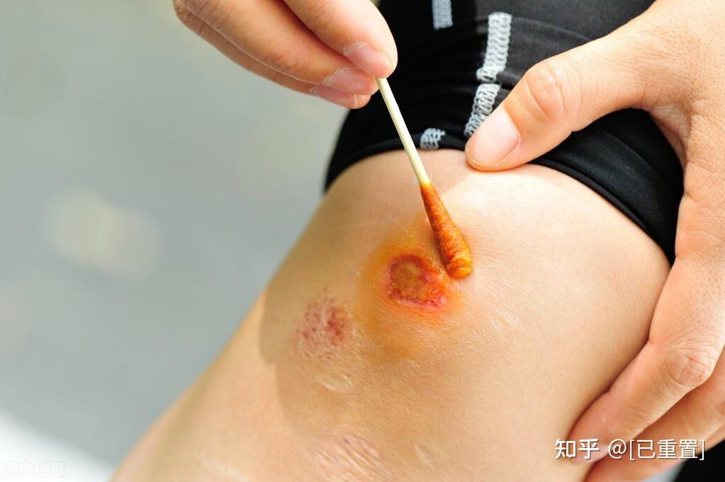伤口红肿 zhuanlan.zhihu.com