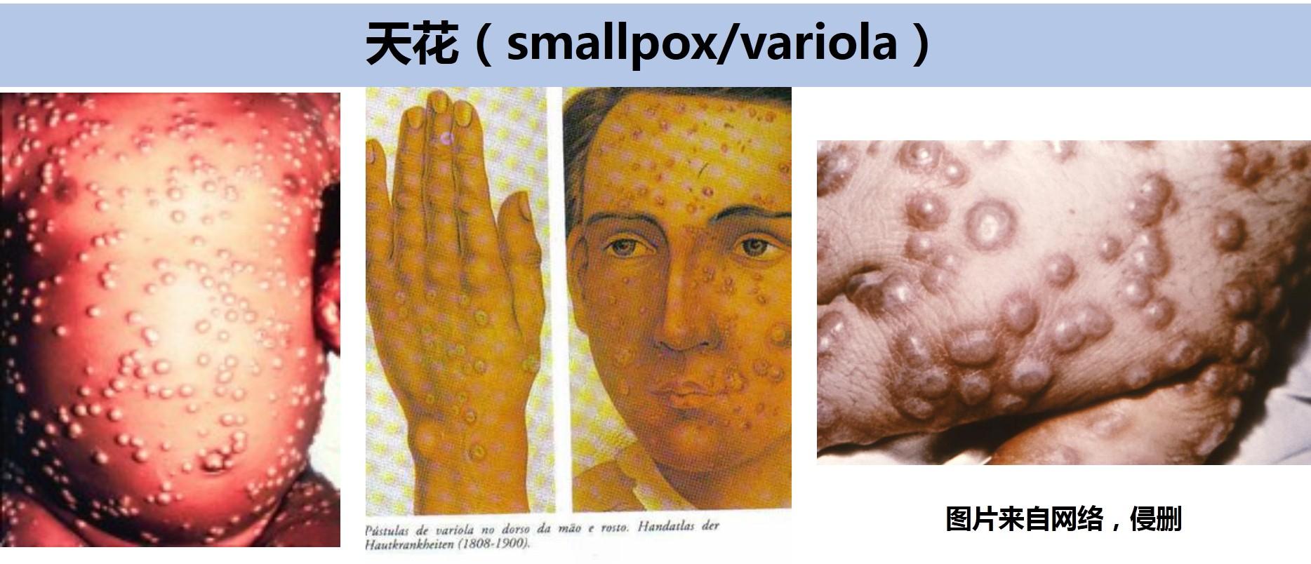 痘病毒2——正痘病毒属 之 天花病毒(variola virus)