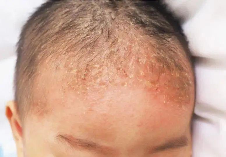 宝宝出生后不久,在头顶部前囱门部位会出现黑色鳞片状融合在一起的硬