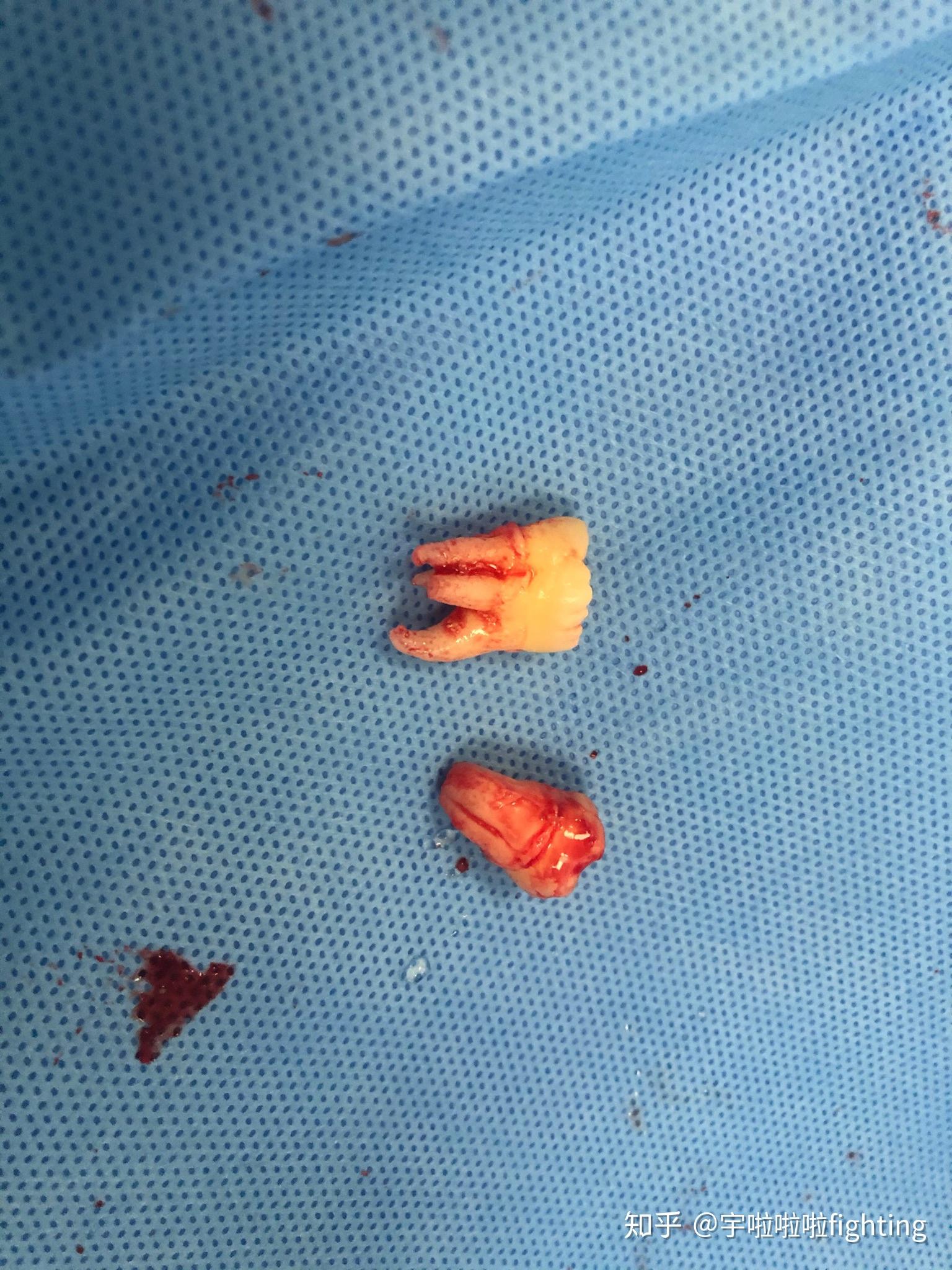 空军军医大学口腔医院拔智齿记录