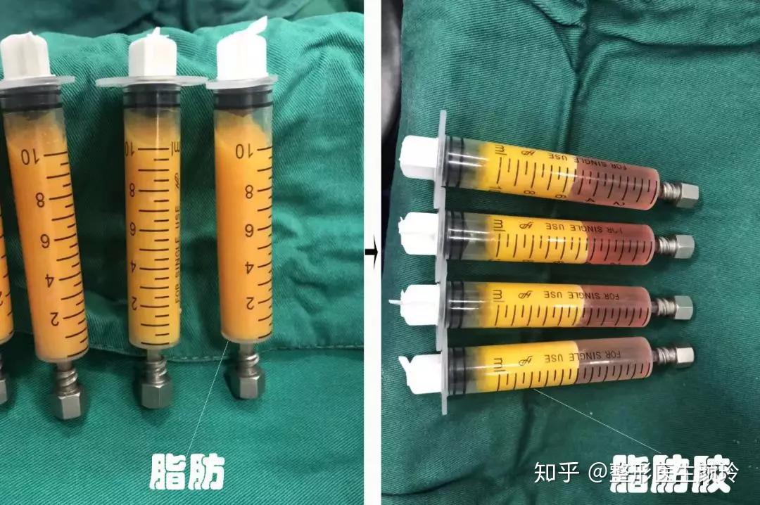 自体脂肪填充和SVF-GEL脂肪胶有什么区别？ - 知乎