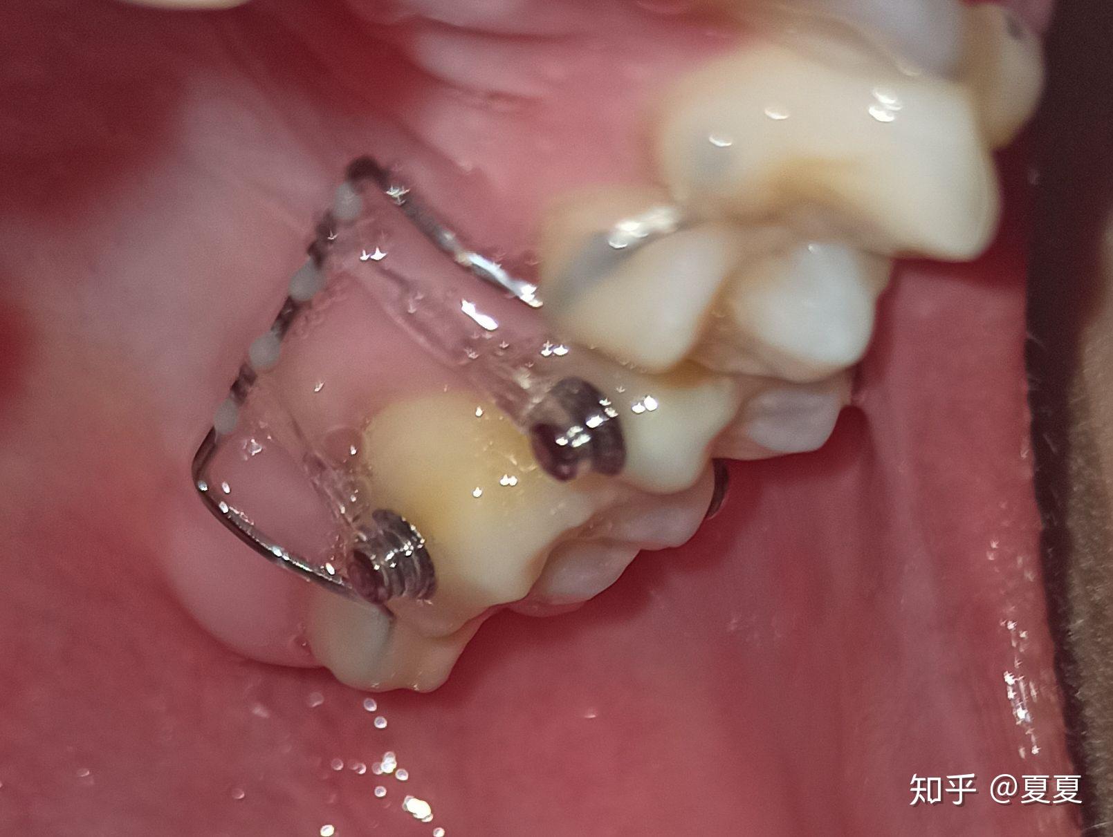 对颌牙伸长怎么办呐