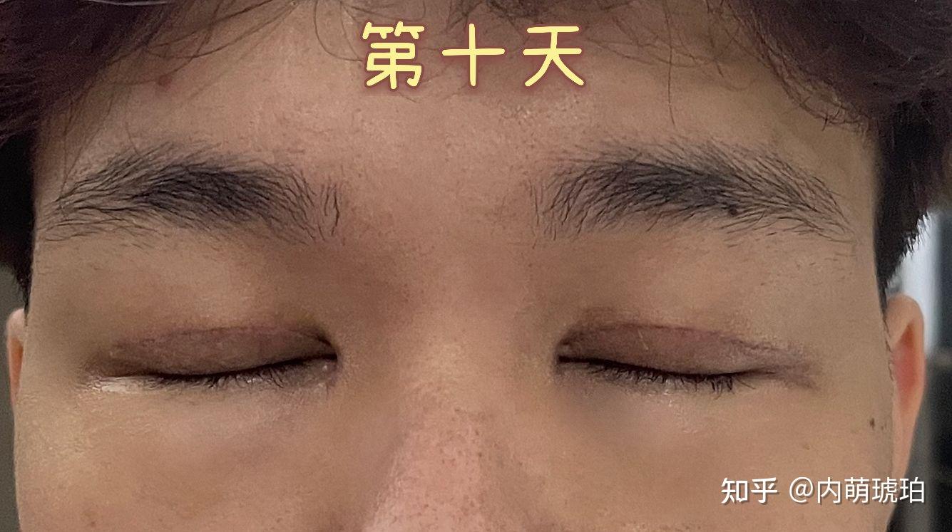 這是篇關於男生全切雙眼皮的記錄貼記錄我的恢復過程