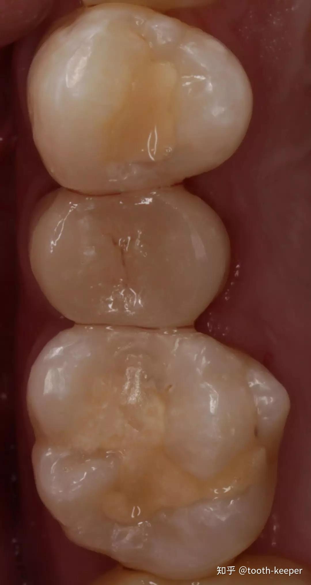 应用irootbp行上颌前磨牙根尖屏障术一例