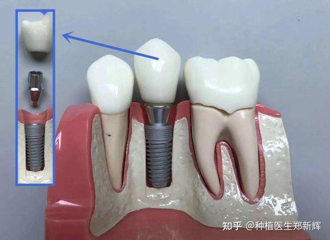 什么时候建议镶牙不要种牙?良心牙医是这么说的-爱康健齿科