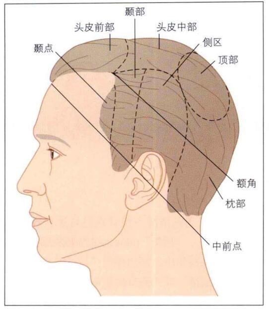 徒手画圆植发(植发图片全过程)