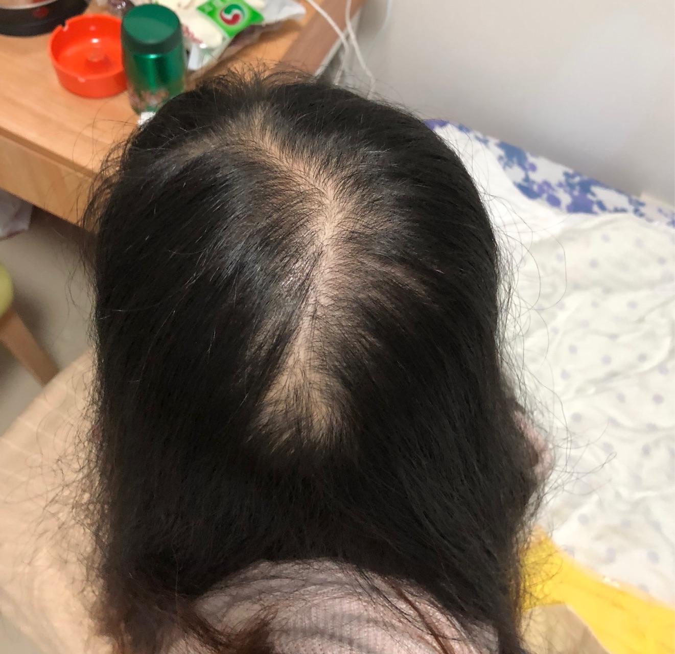 女生头顶头发少是什么体验