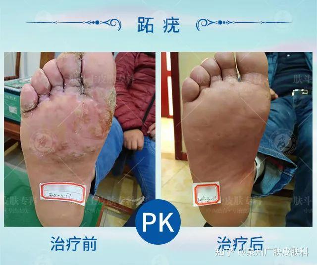 61 足部长期受到摩擦或外伤,皮肤破损;61 免疫力低下,如艾滋病