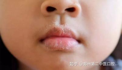 儿童嘴唇干裂怎么办口腔专家教您预防唇炎发作 知乎